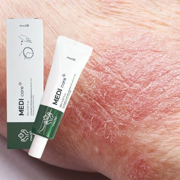 교보문고 이룸 건조한 피부 건선 가려움증 간지러움 땀띠 습진 연고